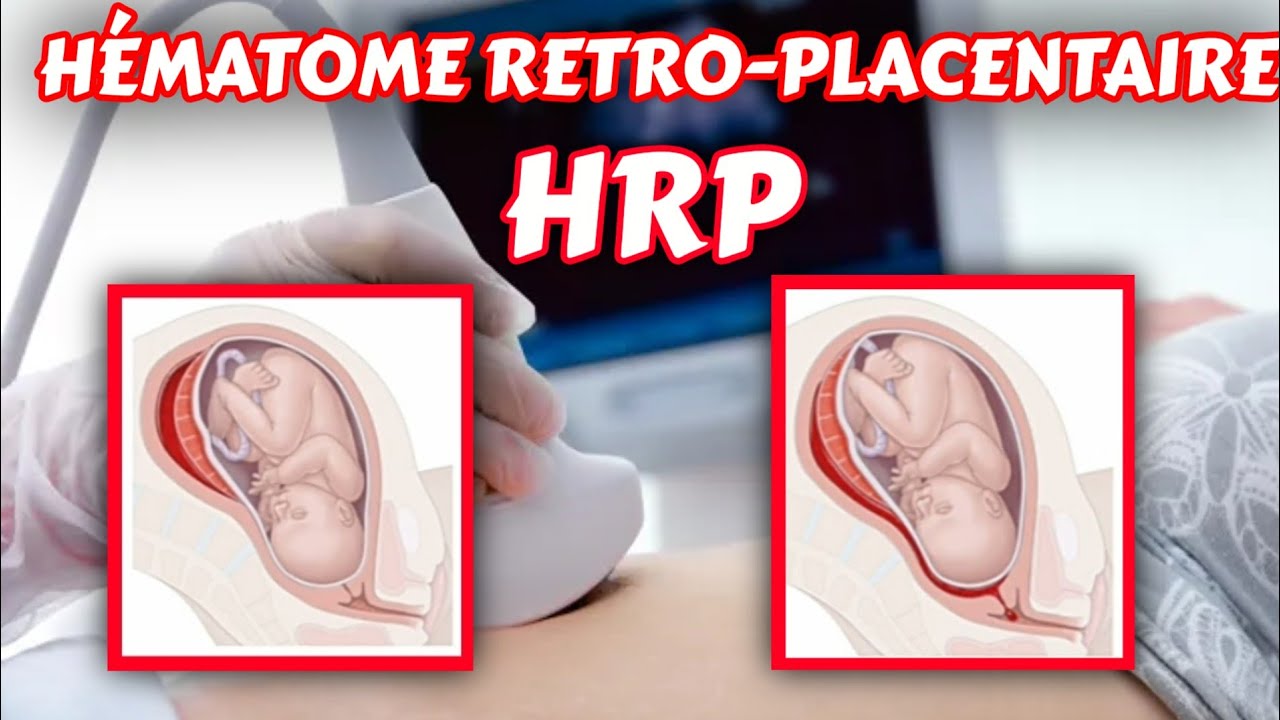 Comprendre l'hématome rétro-placentaire HRP| décollement placentaire