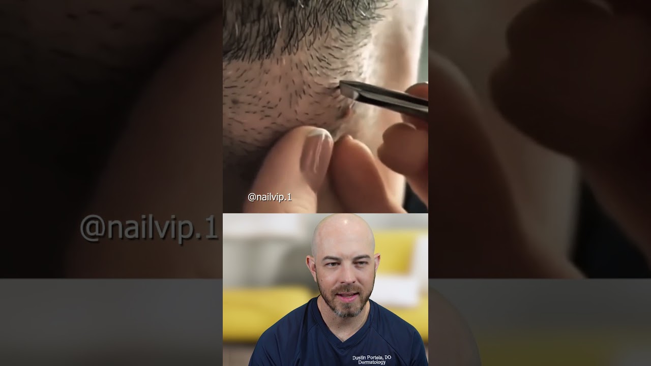 Close-Up: Extracting a Massively Thick Ingrown Hair