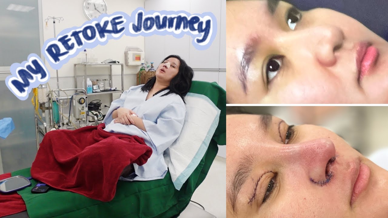 RETOKE DAY na! ( Rhinoplasty and Blepharoplasty sa BELO ) | Kris Lumagui