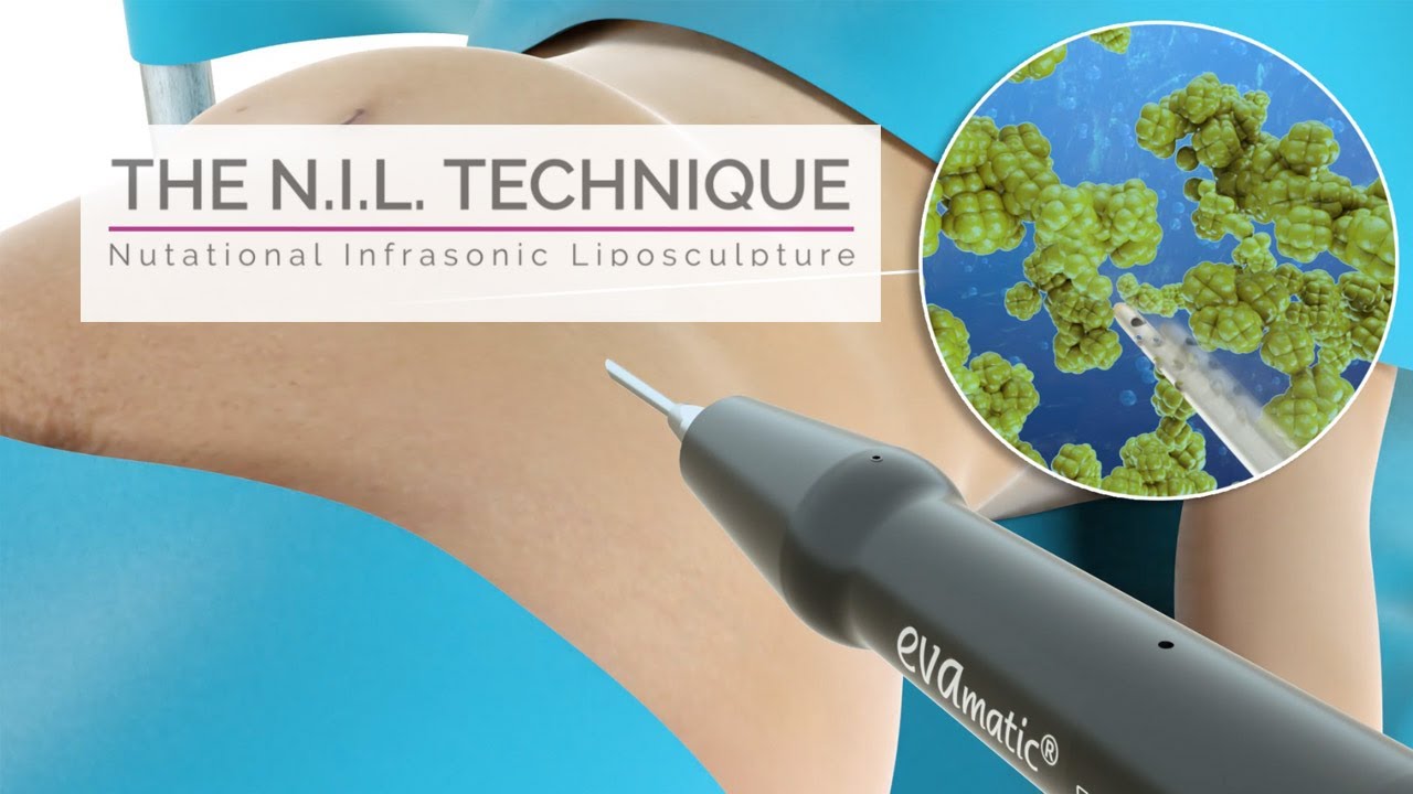 The N.I.L. technique for liposculpture by Euromi