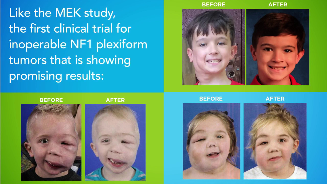 Neurofibromatosis (NF) Awareness Month