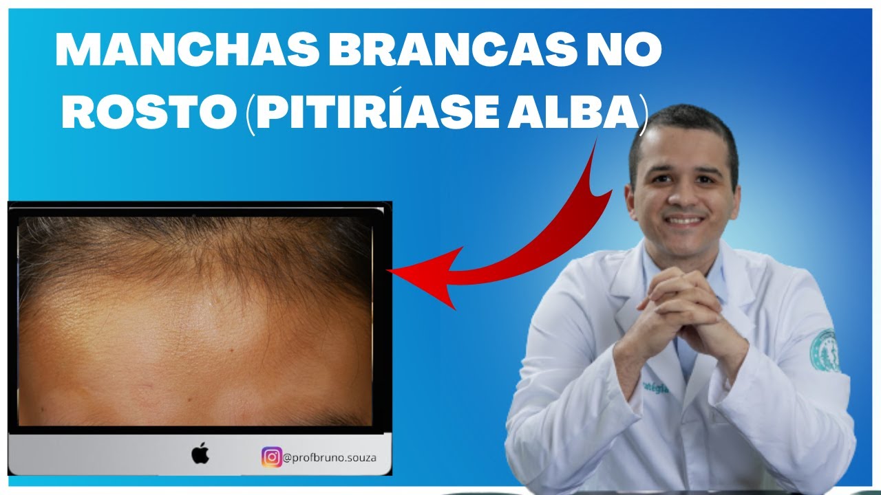 Como tratar pitiríase alba (manchas brancas no rosto)