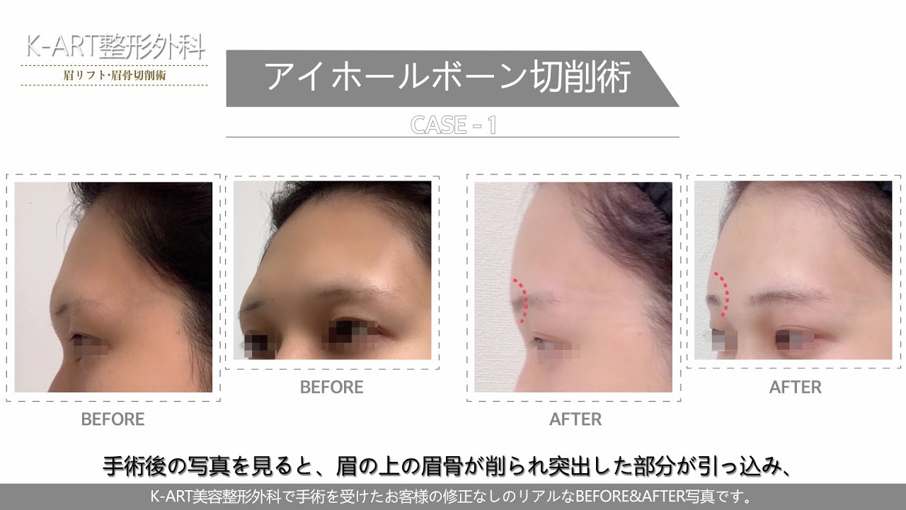 #眉骨切削 #アイホール骨切削 で可能な劇的なイメージチェンジ~額内視鏡手術30年の経歴を持つキム·ナムボク院長 #トランスジェンダー #MTF #K_ART整形外科