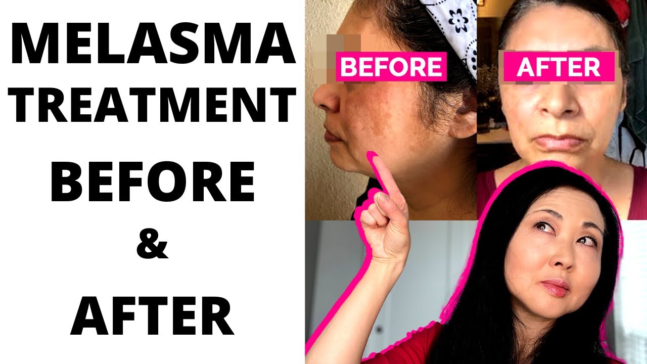 Melasma Treatment Before and After- NO Tretinoin and NO Hydroquinone #melasmatreatment