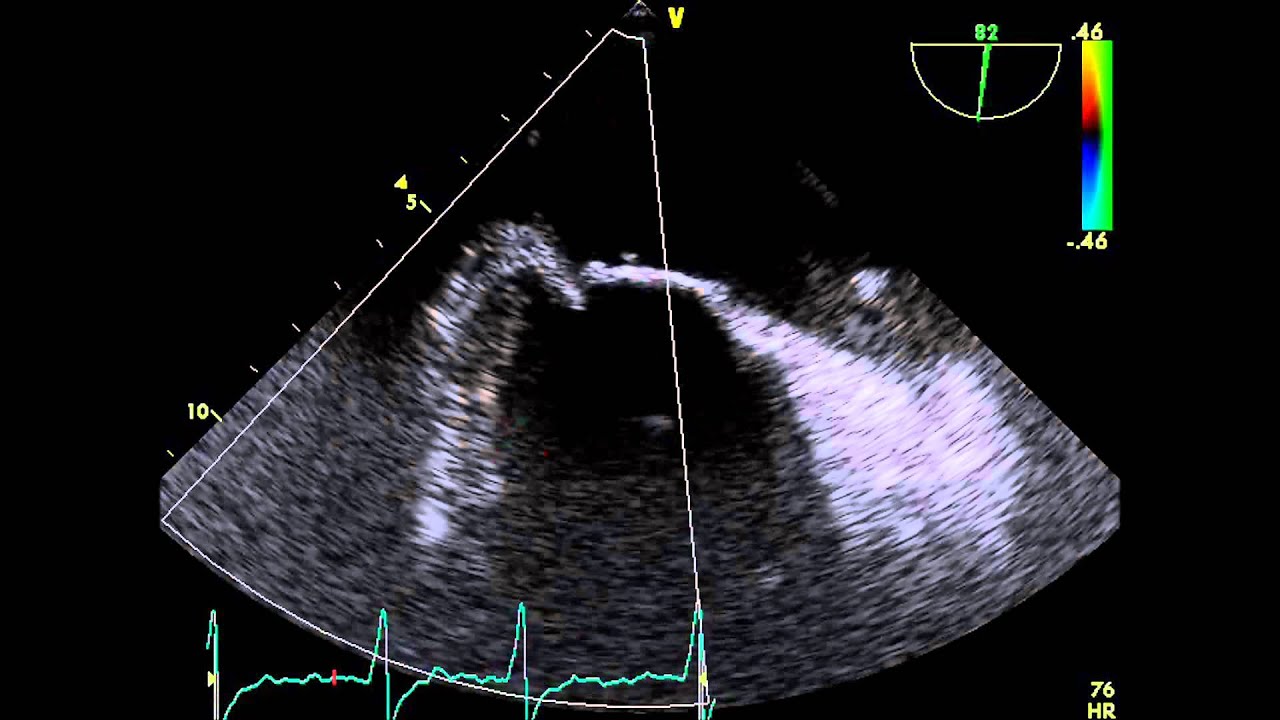 Paravalvular Regurgitation, Paravalv&uuml;ler Reg&uuml;rjitasyon