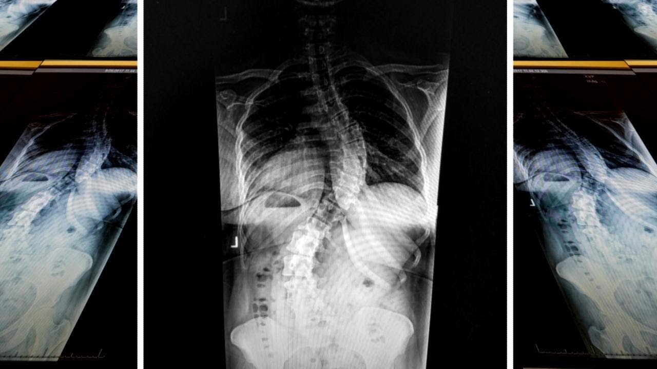 Extreme Scoliosis Could Keep Bride from Walking Down the Aisle