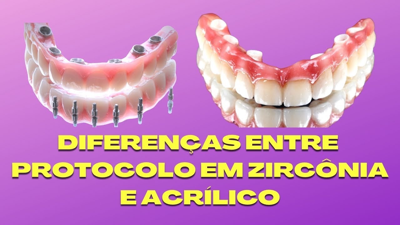 A DIFERENÇA ENTRE PRÓTESE EM ZIRCONIA E ACRÍLICO SOBRE IMPLANTES