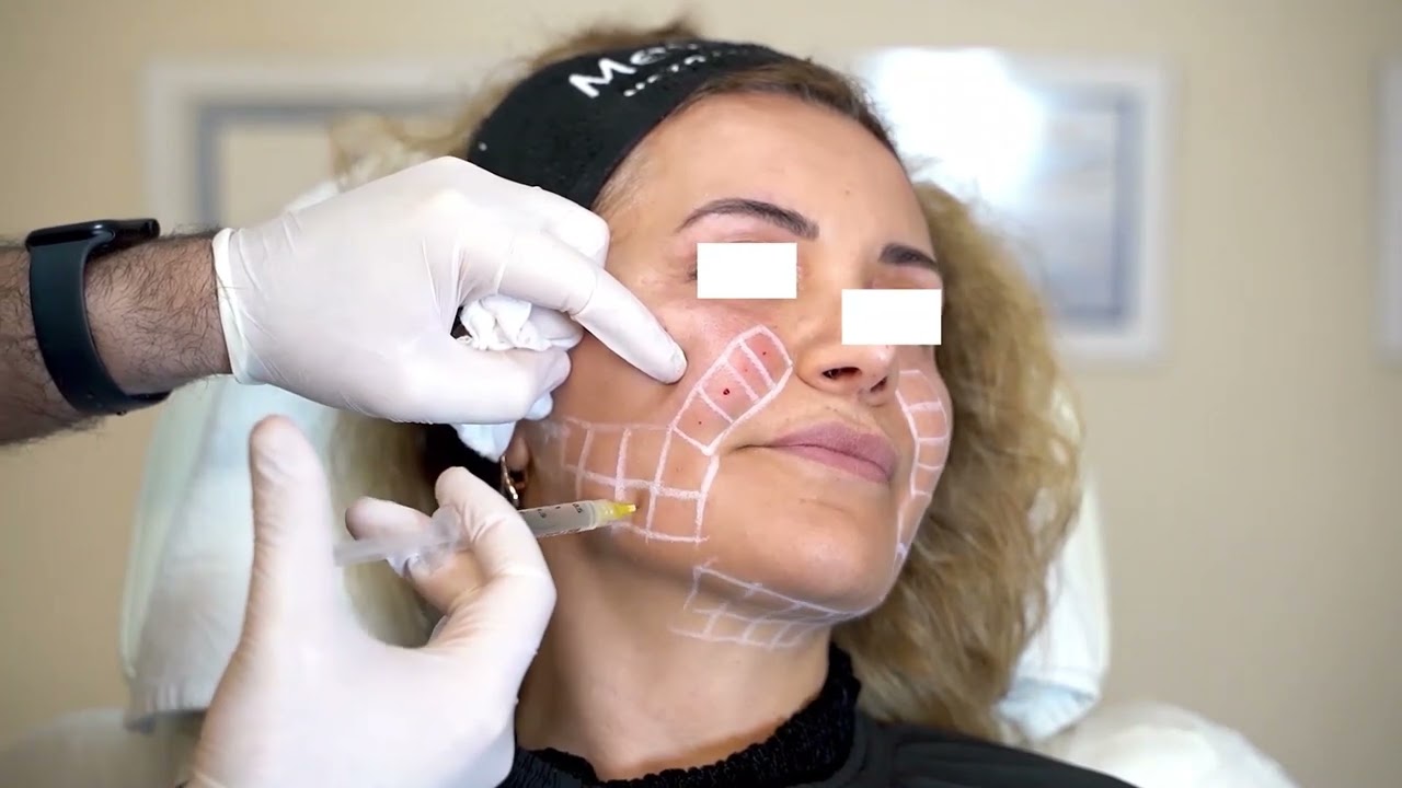 MesoMedica Prime Serisi ile Yüz Rejuvenasyonu (PrimeSlim - PrimEyes - PrimAge) Dr. Emre Araz