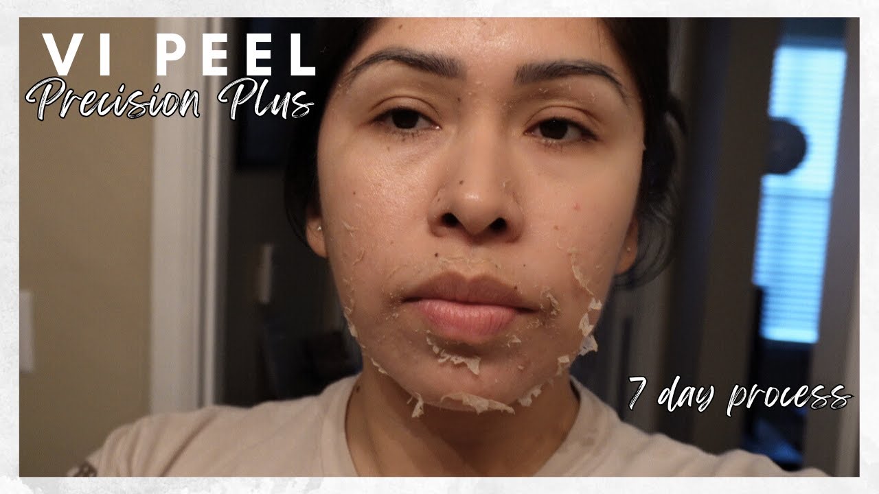 My VI Peel Precision Plus Journey | mini vlog, skin transformation journey