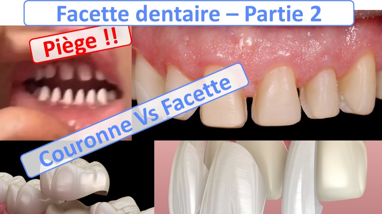 Facette dentaire : Facette Vs Couronnes, Piège à éviter - Guide complet - partie 2