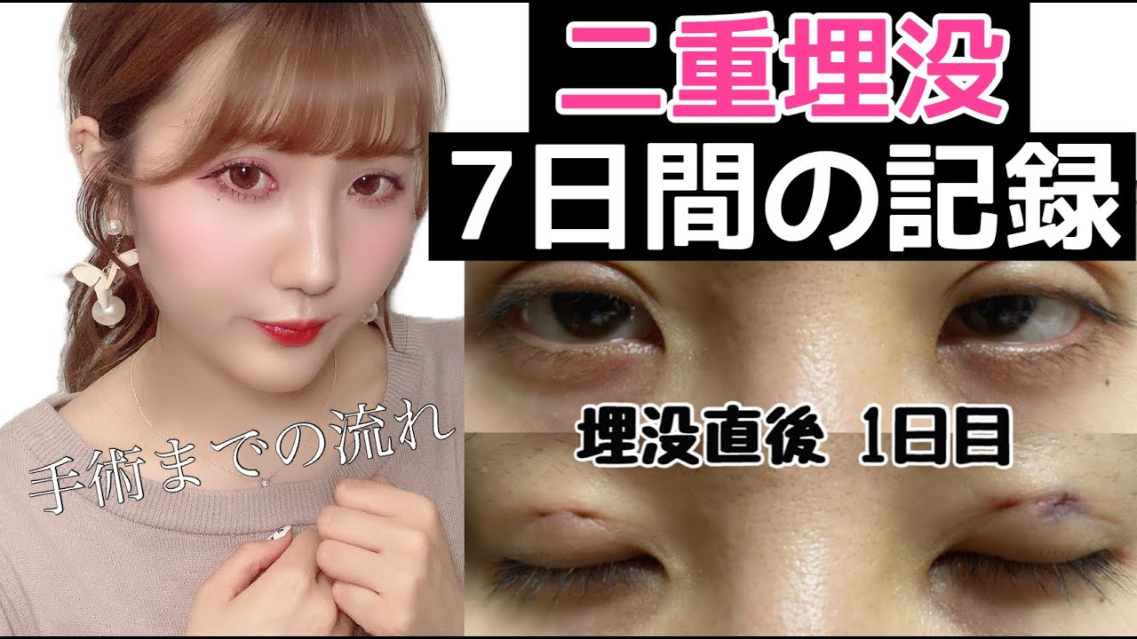 【二重埋没】ダウンタイムの７日間と感想！！