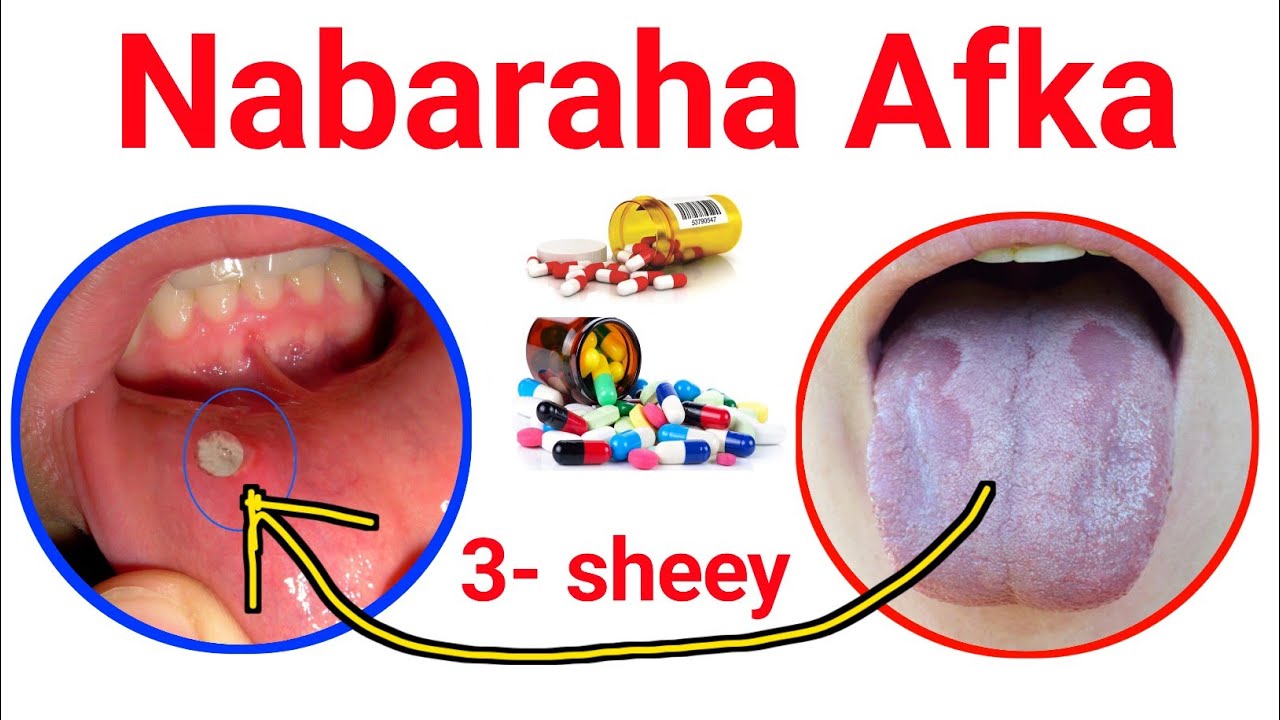 Nabaraha Afka gudihiisa ee loo laalaabta ee xanuunka badan  3- sheey oo sababta iyo xalka