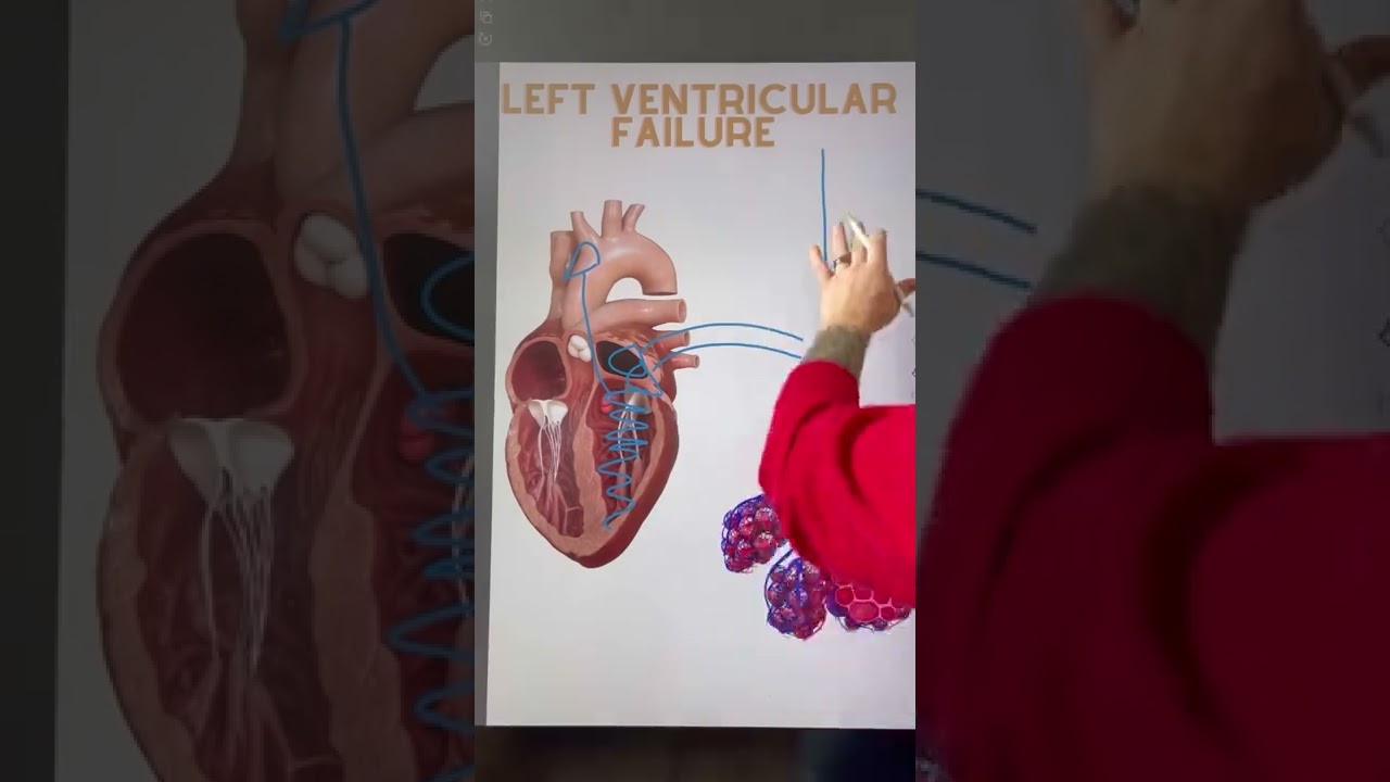 Левожелудочковая недостаточность