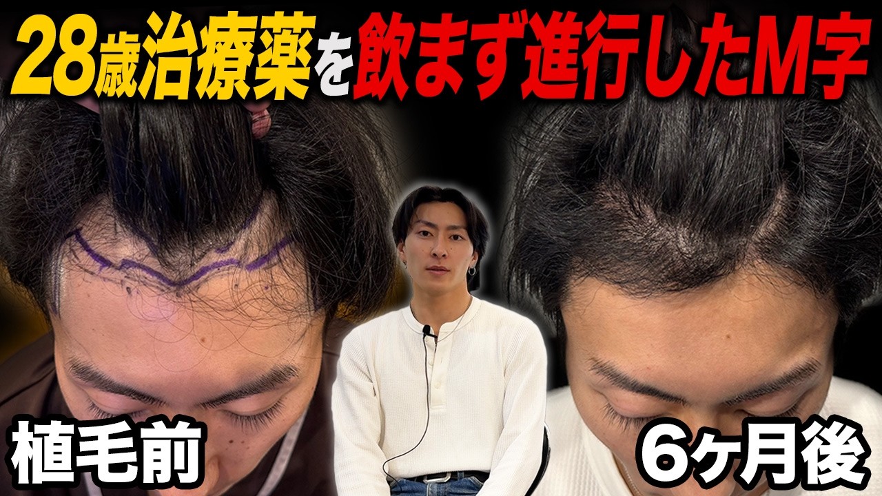 【植毛6ヶ月】高校生の頃から薄毛に気づいていた28歳M字のリアルな結果