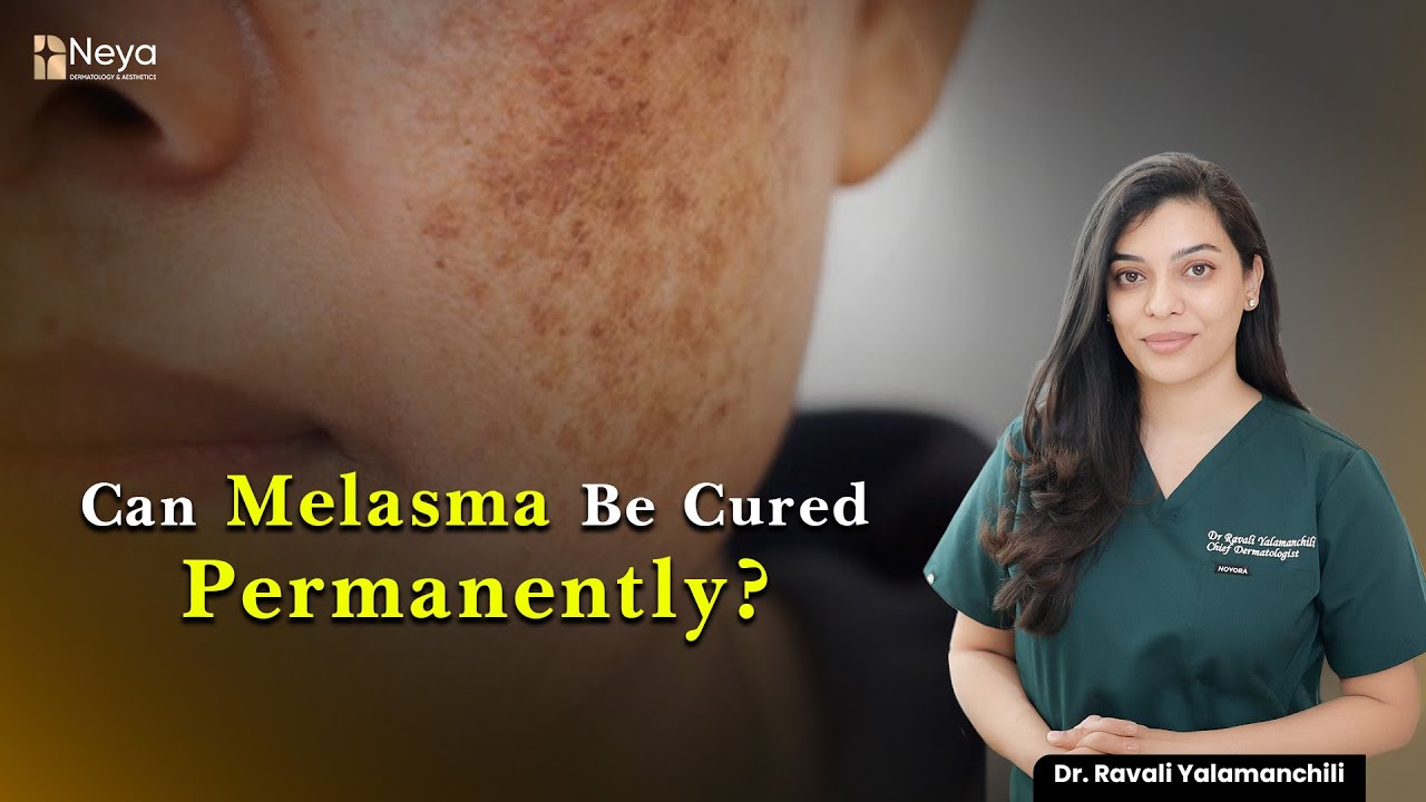 Can Melasma be cured completely | Skin Doctor in Hyderabad