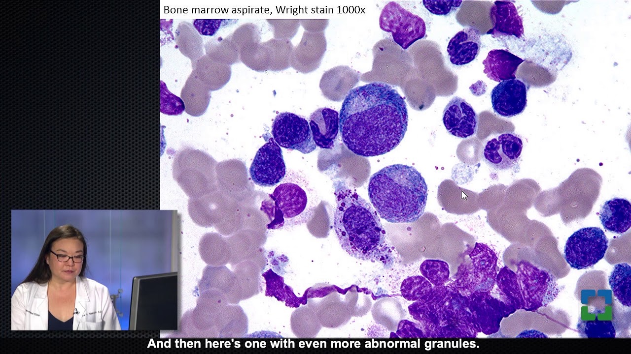 Two Diagnoses in One Bone Marrow with Megan Nakashima, MD