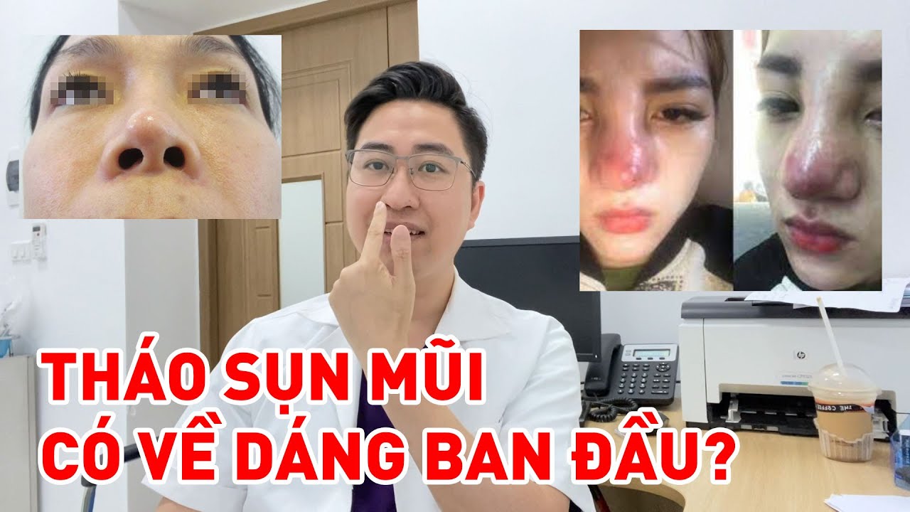Vén màn sự thật: Tháo sụn mũi có trở về dáng mũi ban đầu? | Bs Mạnh