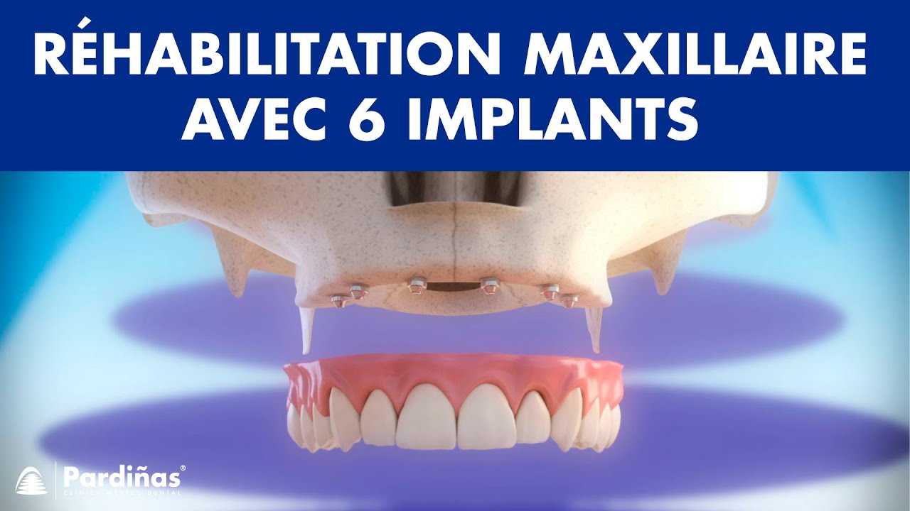 Réhabilitation du maxillaire avec 6 implants dentaires ©