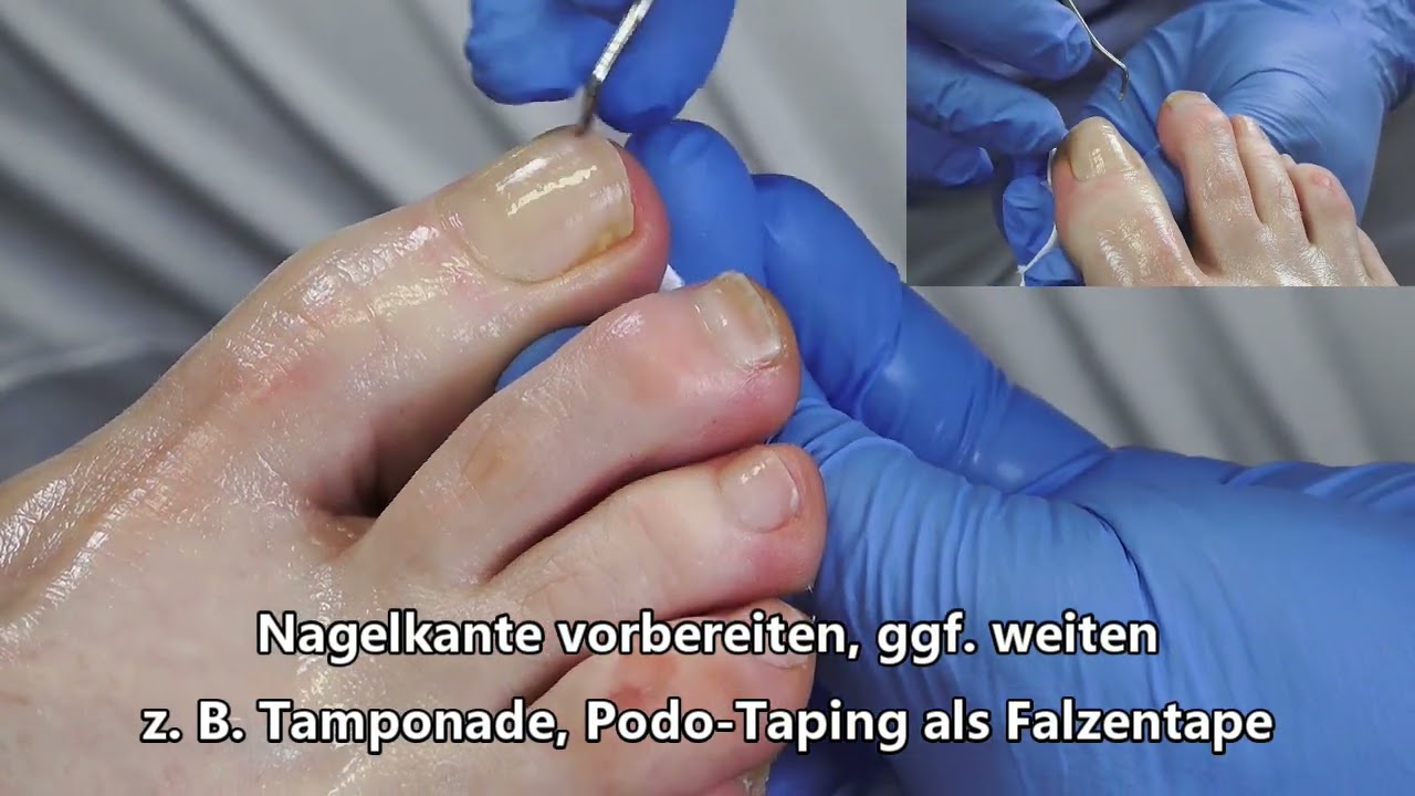 Nora Nagelspange, Podologie , eingewachsener Nagel Teil 1: Vorbereitung