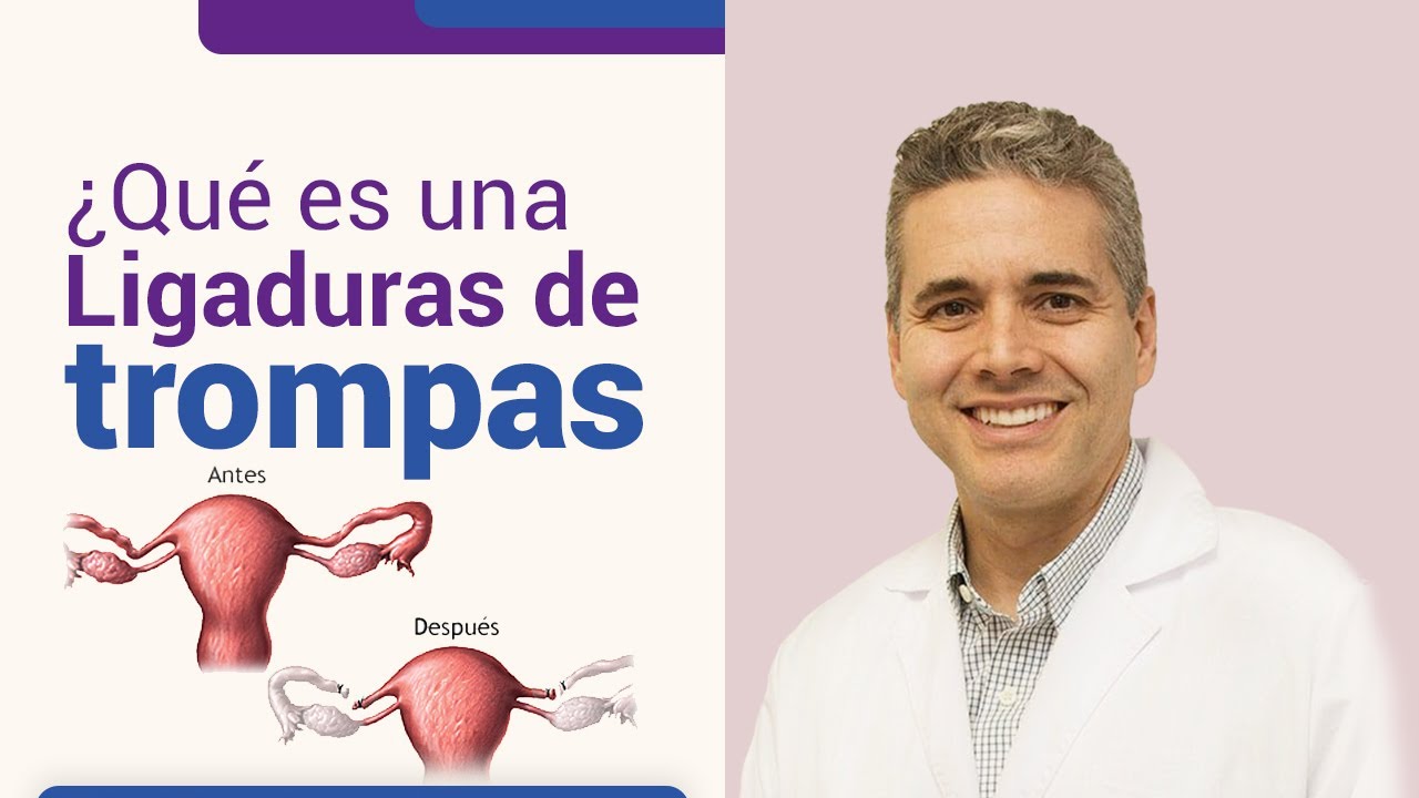 Qué es una ligadura de trompas l Dr. Juan Luis Giraldo