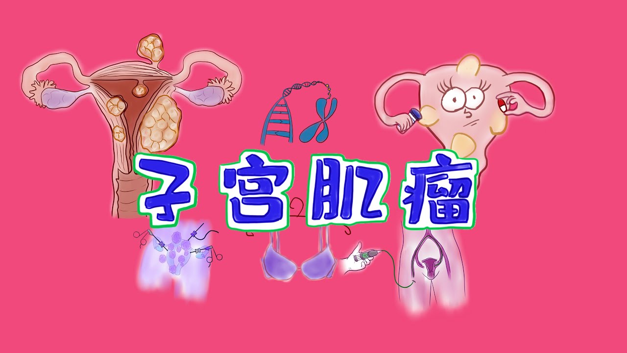 生命科学动漫|子宫肌瘤的一切：病因和发病机制+临床表现+诊断+治疗uterine fibroids: etiology  + symptoms + diagnosis + treatment