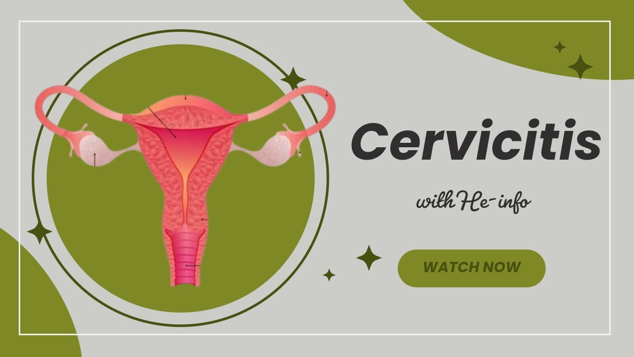 Cervicitis: Symptoms, Causes, and Treatment | He-Info Channel
