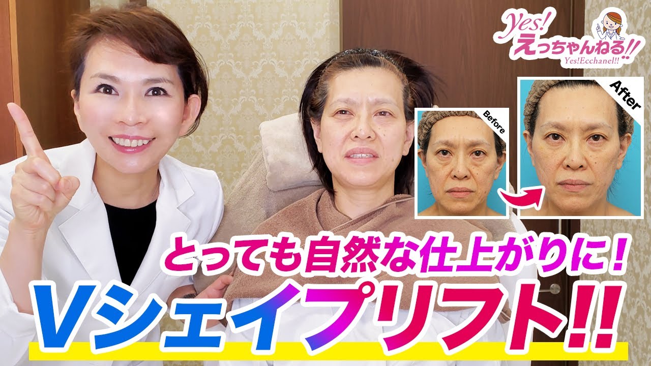 自然な仕上がり！Vシェイプリフトと眉間ボツリヌストキシン注射でリフトアップ！