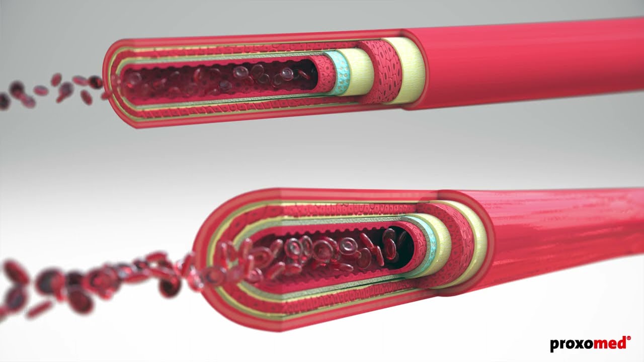 vacumed – Einsatz der IVT bei arteriellen Erkrankungen und Diabetes