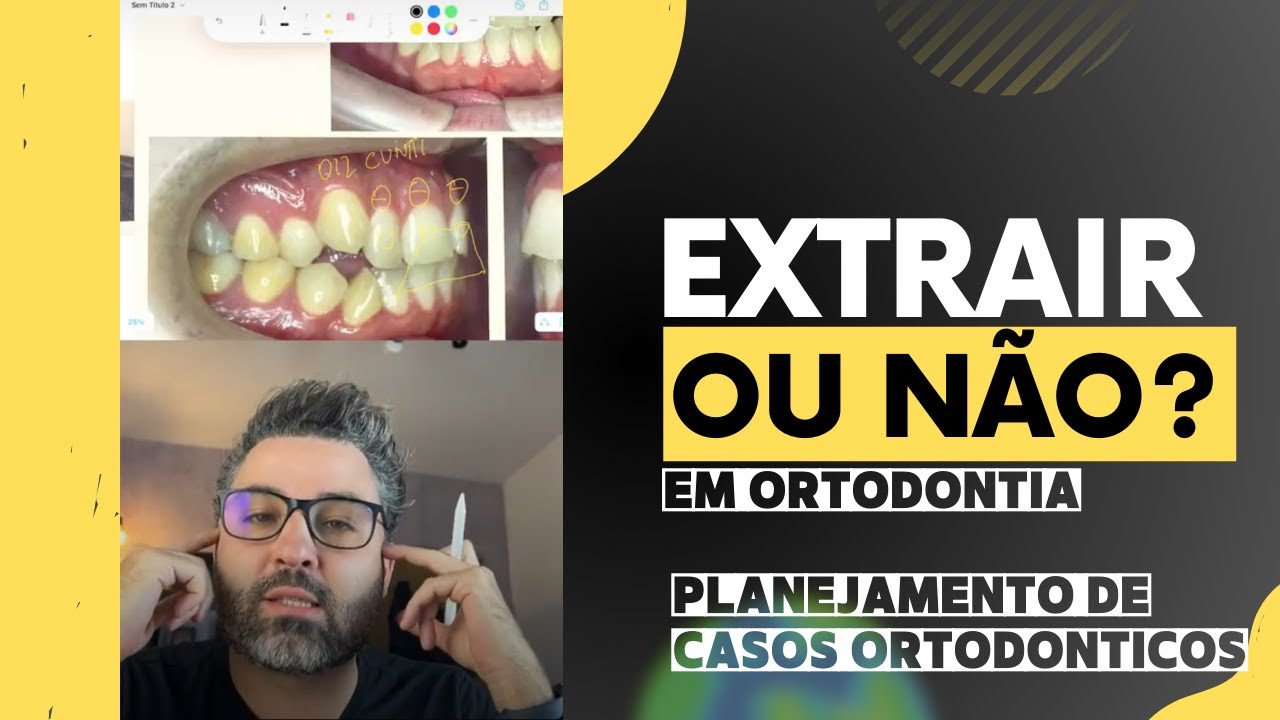 Como evitar arrependimentos na extra&ccedil;&atilde;o em ortodontia