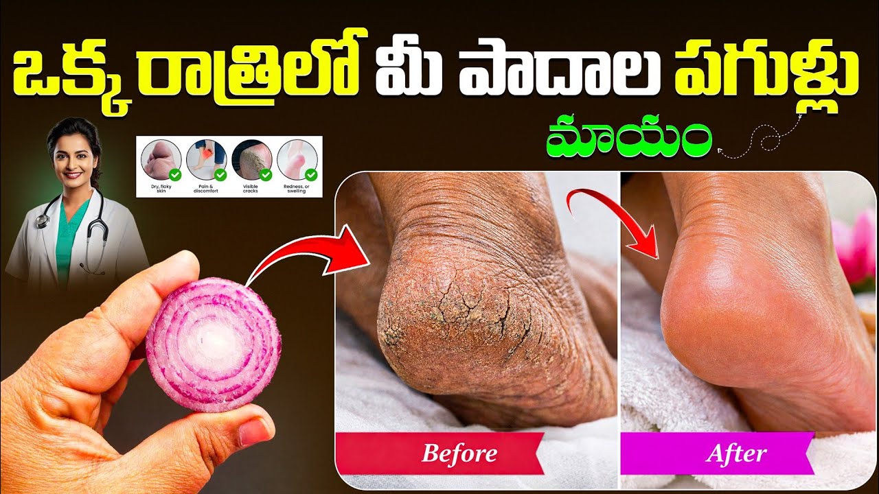 ఒక్క రాత్రిలో మీ పాదాల పగుళ్లు మాయం | Heel Cracks Home Remedy in Telugu | Ksk Home