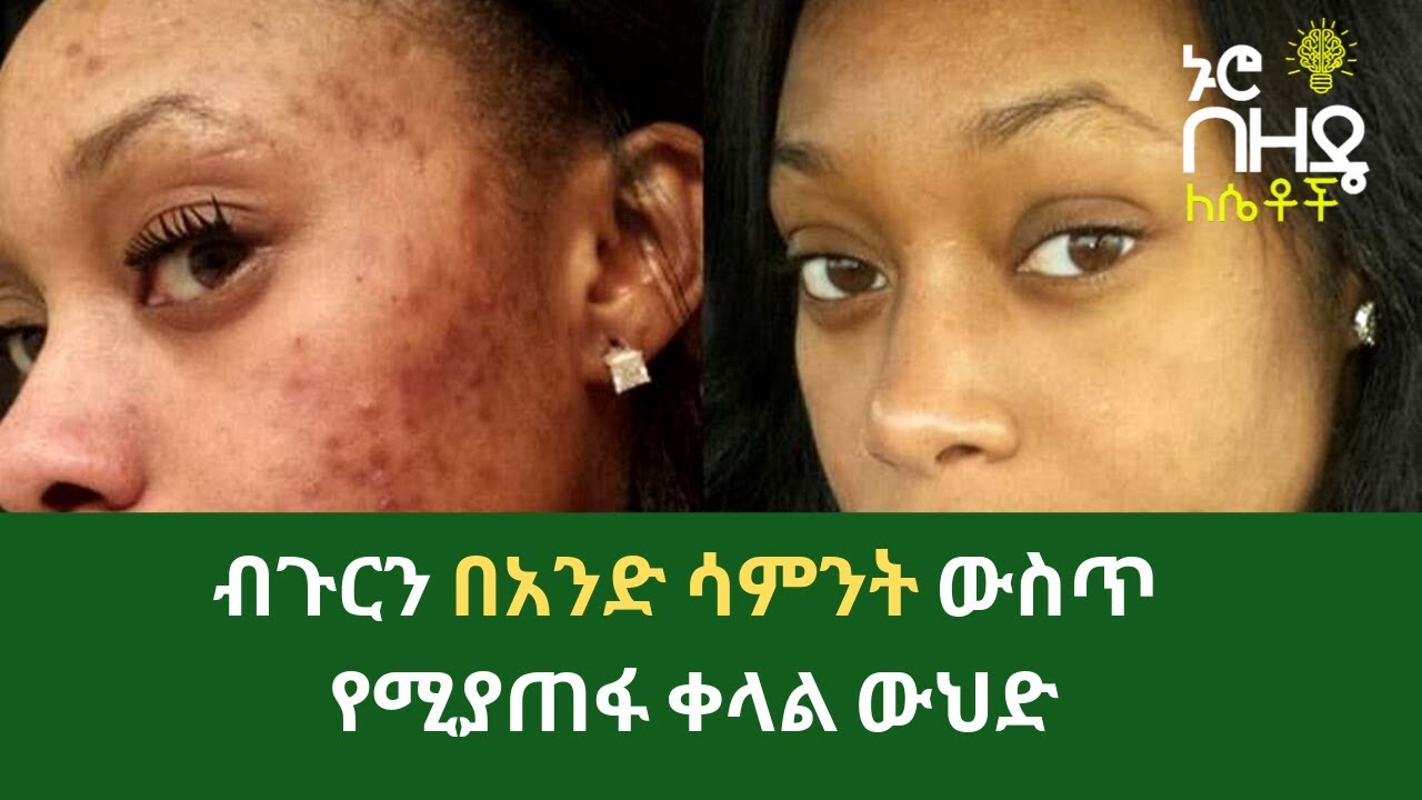 ETHIOPIA:- ብጉርን በአንድ ሳምንት ውስጥ የሚያጠፋ ቀላል ውህድ | Nuro bezede Girls