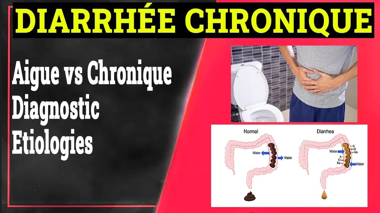Diarrhée Chronique: Définition, Causes, Formes Cliniques.. | Gastrologie Medicale