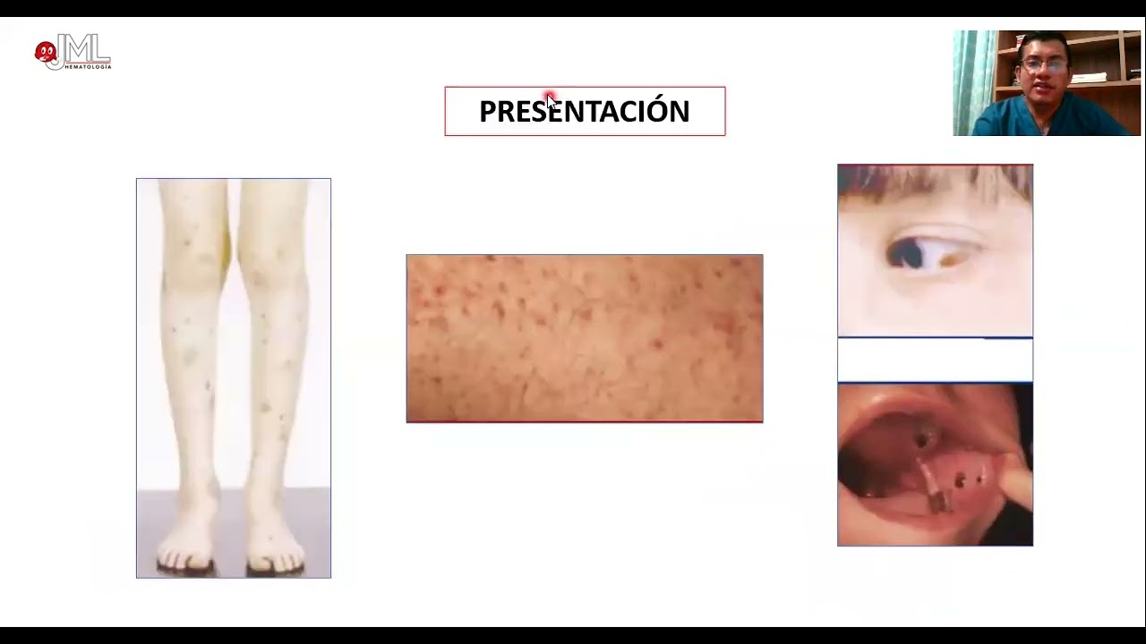 APLASIA MEDULAR. ABORDAJE DIAGNÓSTICO. PARTE 2