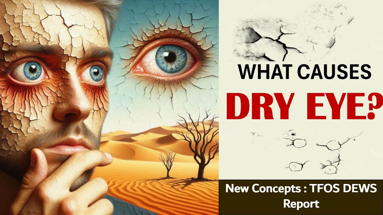 The Vicious Cycle of Dry Eye: Causes, Hyperosmolarity, and Inflammation Explained!