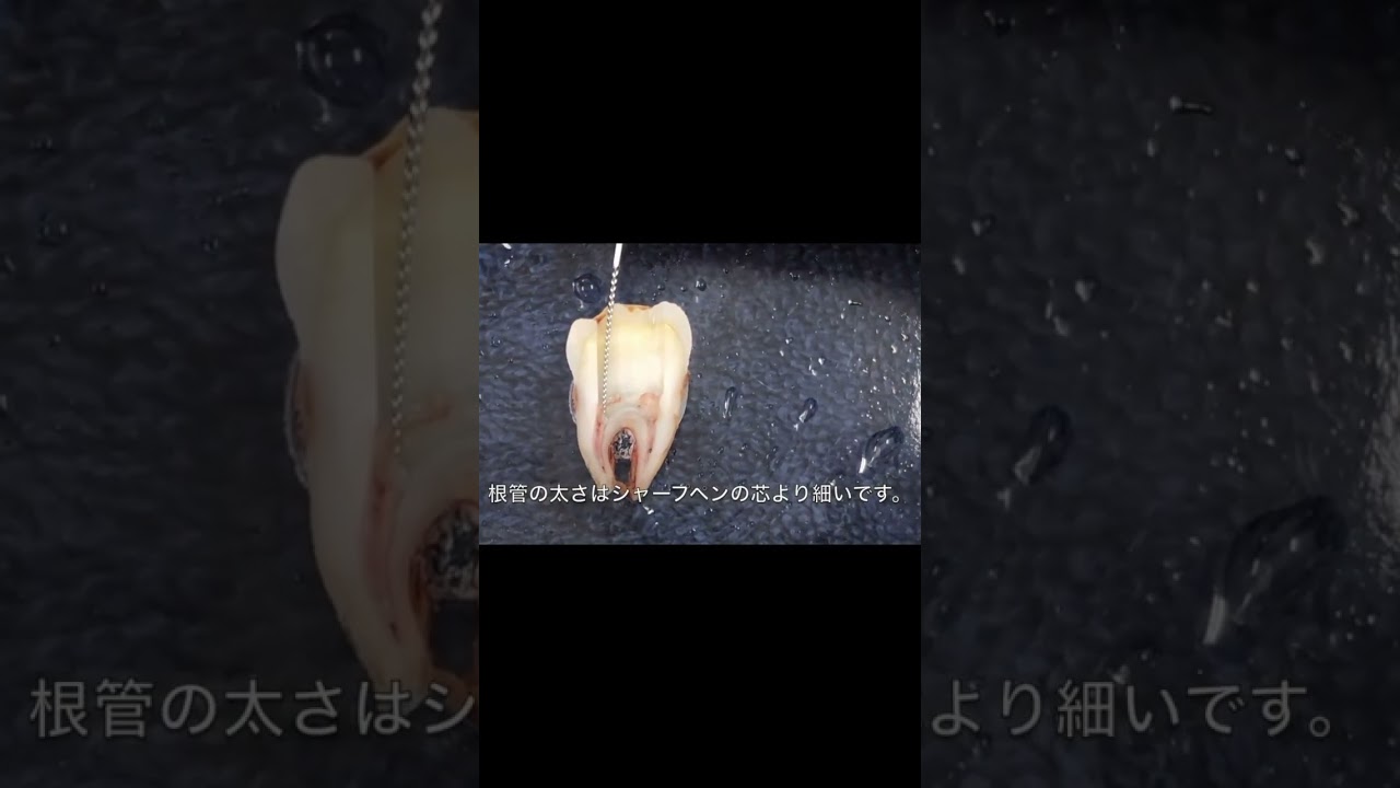 【戸塚駅前内藤歯科】歯の神経をとる抜髄とは？#shorts #虫歯かなと思ったら歯医者さんへ
