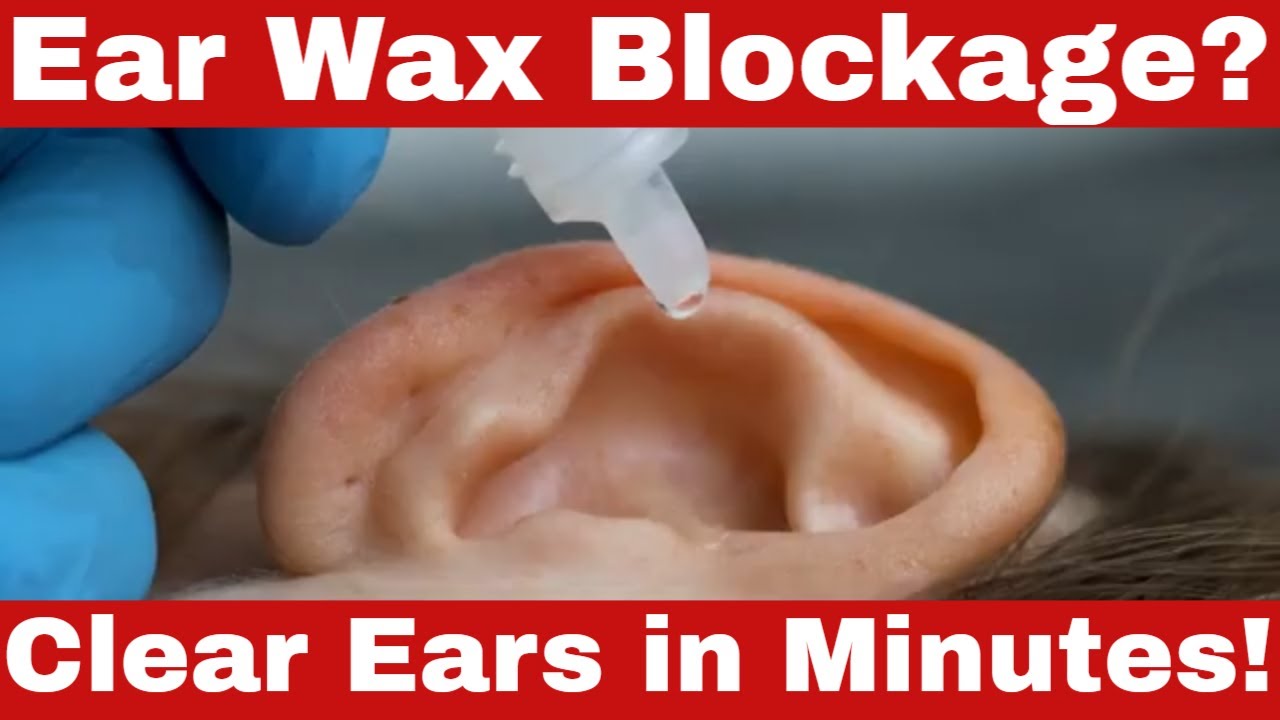 How to Remove Ear Wax Blockage Fast &ndash; Proven Home Remedies for Ear Wax Blockage