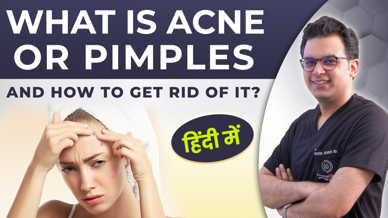 What is Acne or Pimples and How to Get Rid of Acne?| Causes and Symptoms | How To Treat Acne & Scars