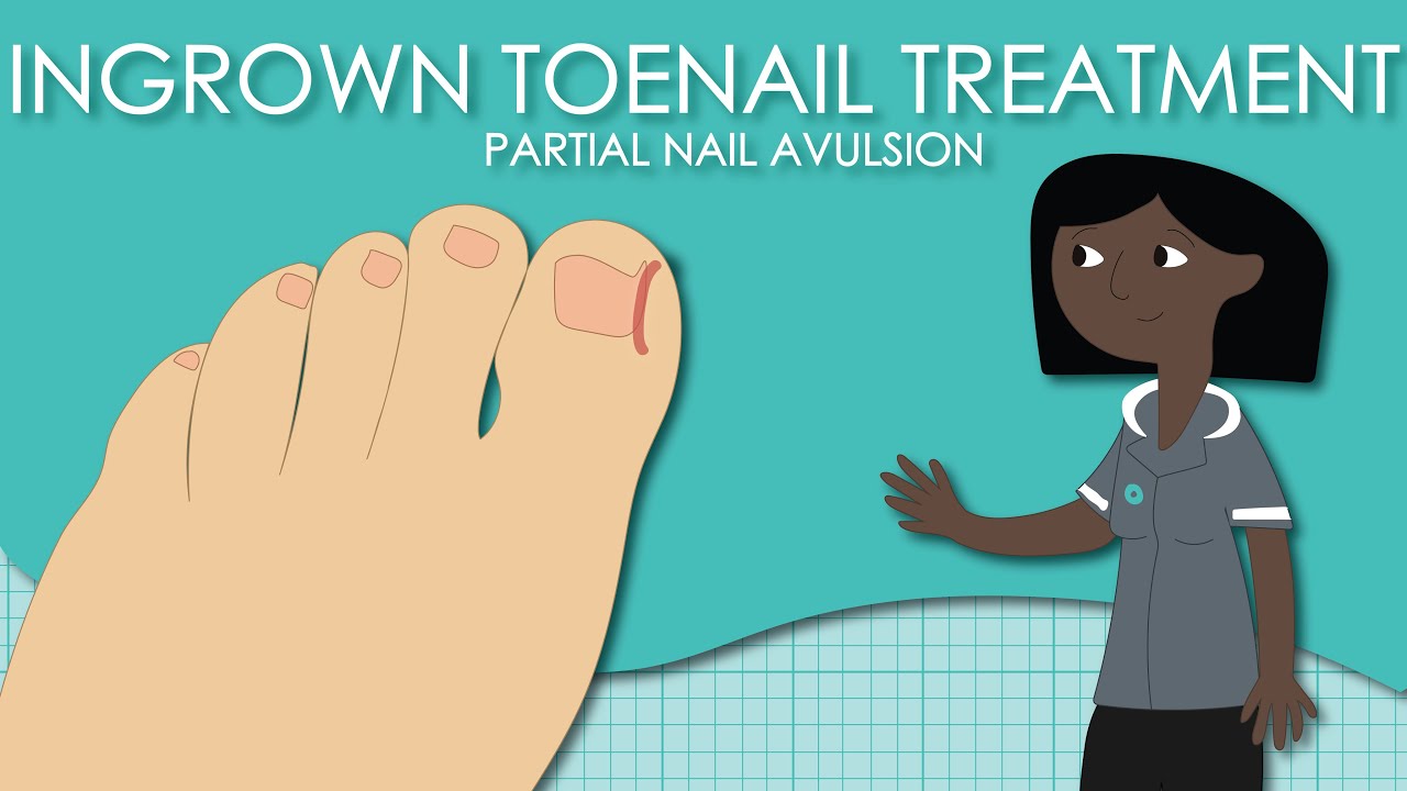 Ingrown Toenail Treatment: Partial Nail Avulsion