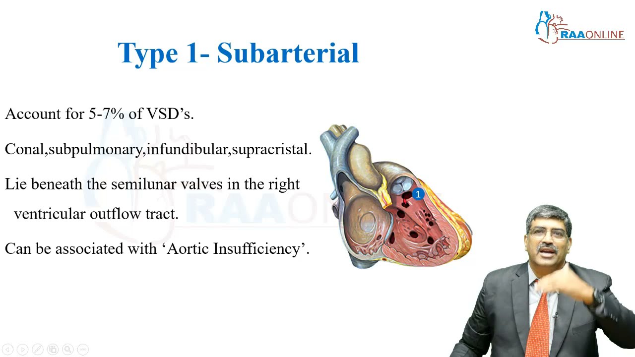 Ventricular Septal Defect - Master Class in Cardiology
