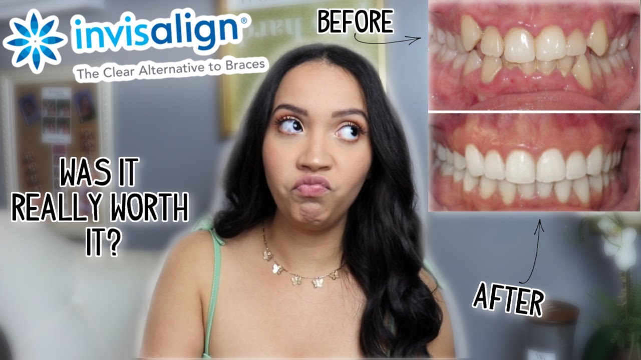 INVISALIGN REVIEW IS IT WORTH IT?