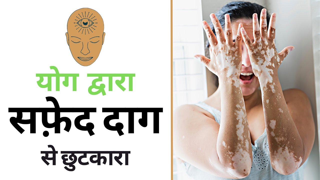 सफेद दाग का रामबाण इलाज | घरेलू उपचार | Yoga for Leucoderma in Hindi
