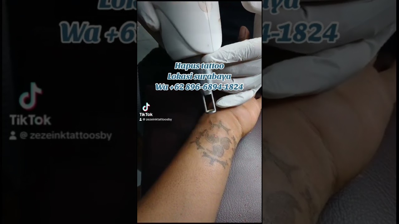 Hapus tattoo teknik laser lokasi surabaya