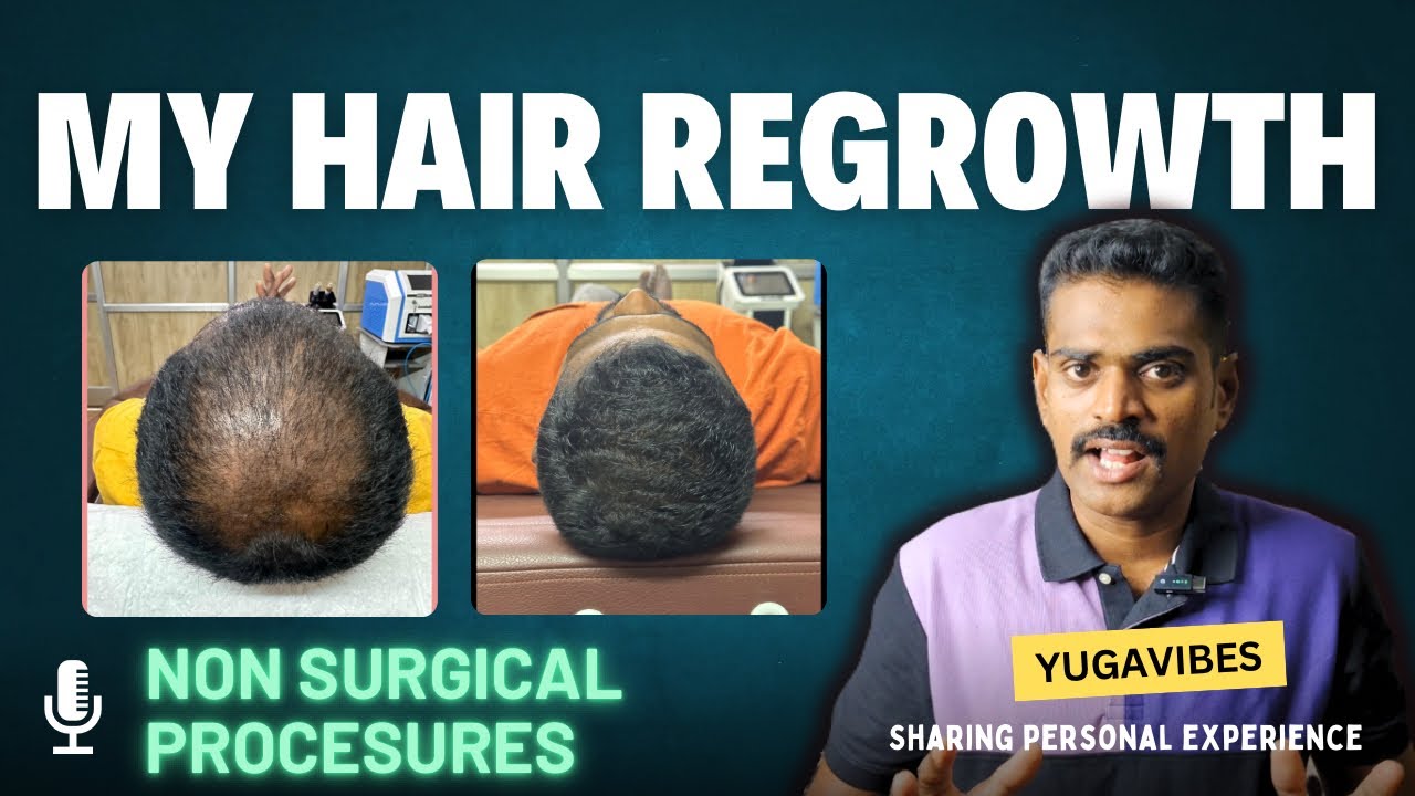 How i regrow my hair without hair transplant| Hair loss in Tamil #hair #haircare #transformation