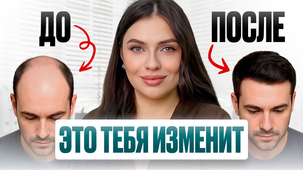 Новая шевелюра за 1 день. Вся правда о пересадке ВОЛОС!