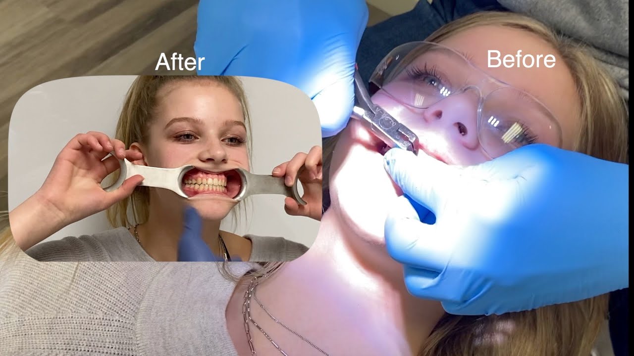 the time i got my braces off