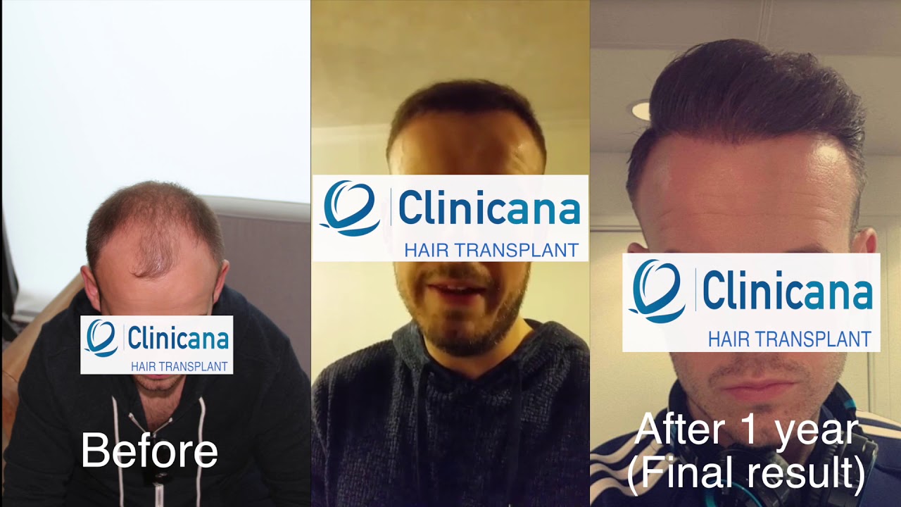 Hair Transplant London, Manchester, Birmingham or Turkey Istanbul!