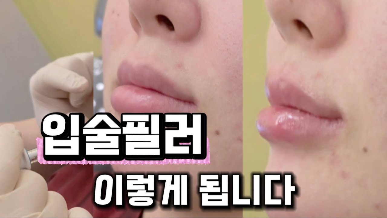 입술필러 한번에 과한용량하지마세요! 입술필러시술영상