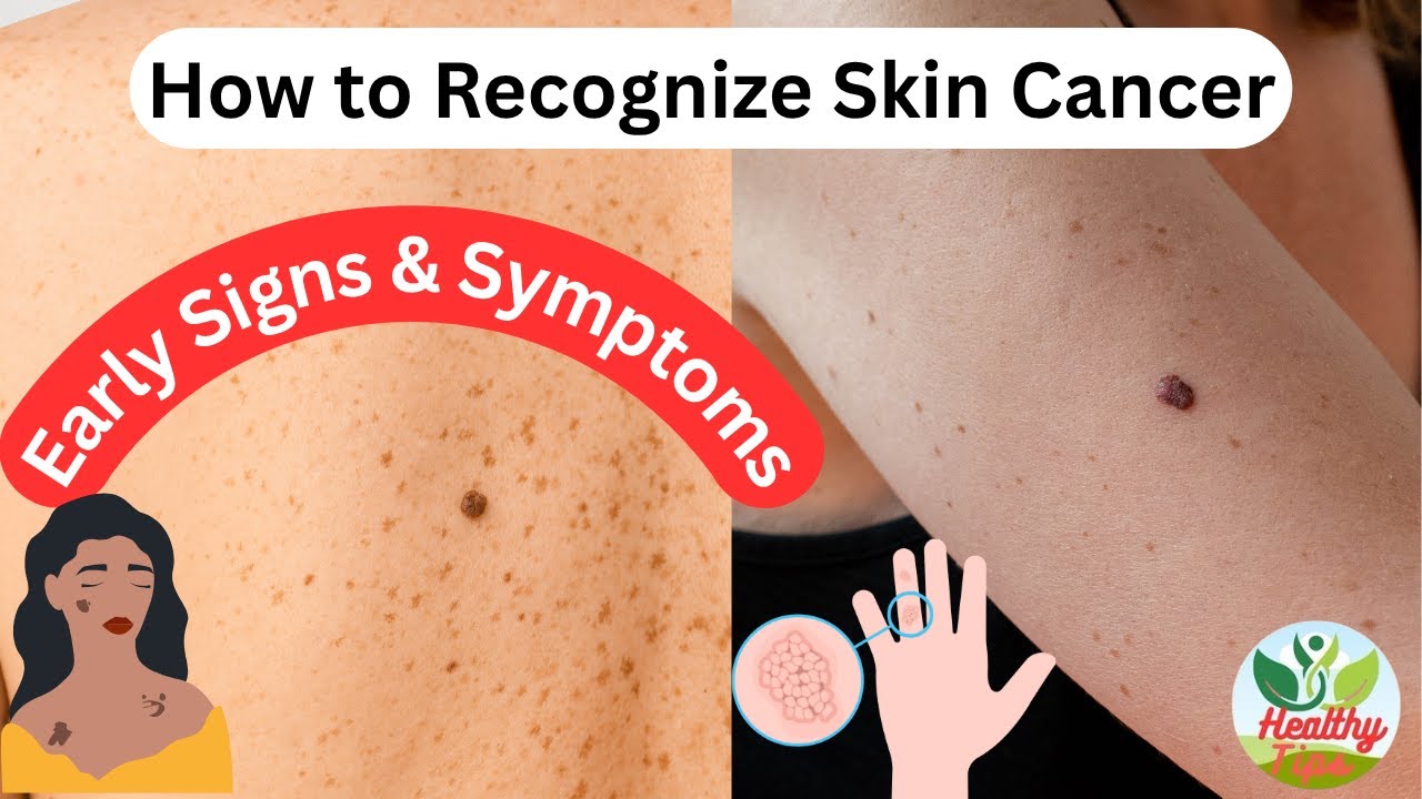 How to Recognize Skin Cancer Early Signs Symptoms