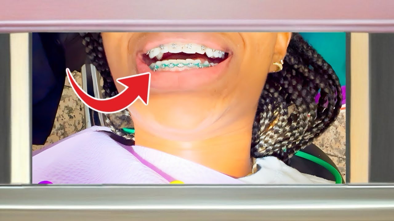 WATCH ME GET POWER CHAINS ON MY BRACES. 