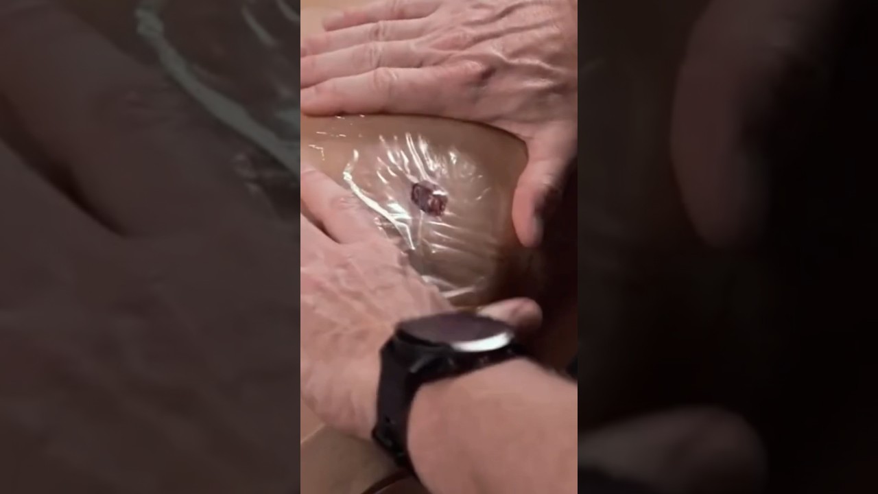 Treating a Gun Shot Wound